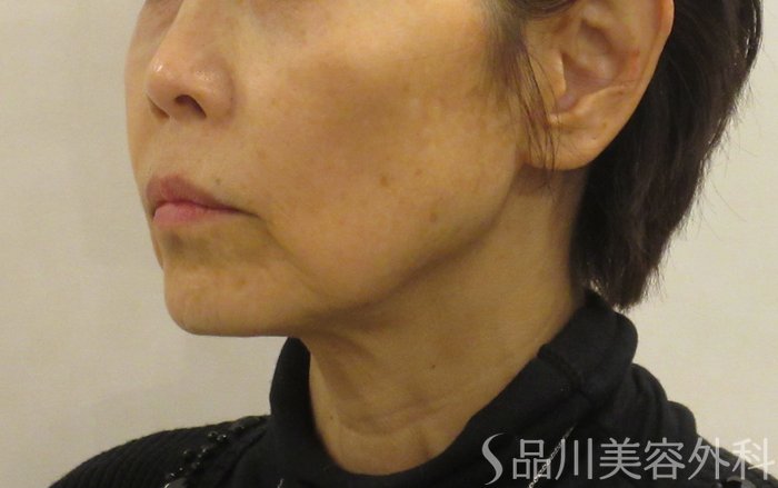 症例NO.68405のBEFORE写真