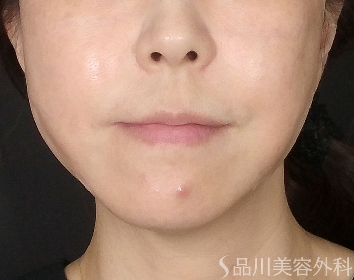 症例NO.65164のAFTER写真