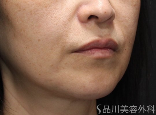 症例NO.75263のBEFORE写真