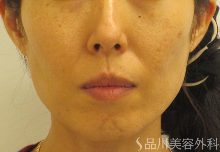 症例NO.71371のBEFORE写真