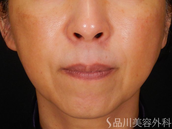 症例NO.67888のBEFORE写真