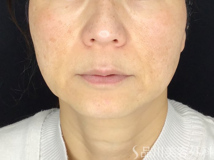 症例NO.69592のBEFORE写真