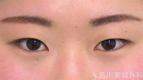 症例NO.26258のBEFORE写真