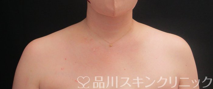症例NO.74935のBEFORE写真