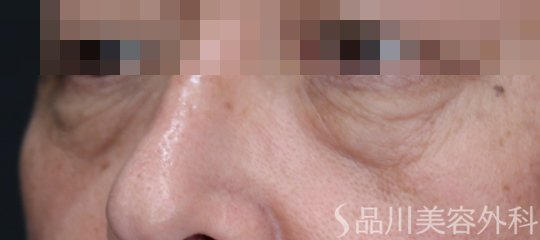 症例NO.72937のBEFORE写真