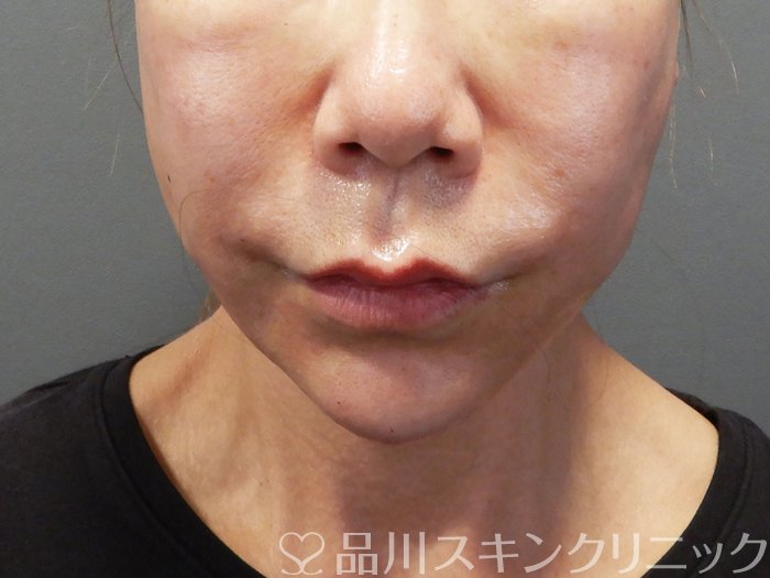 症例NO.72812のAFTER写真