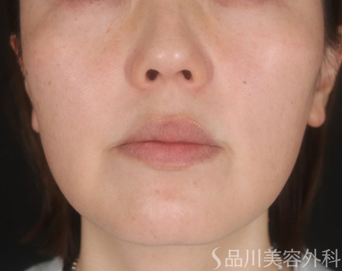 症例NO.73093のBEFORE写真