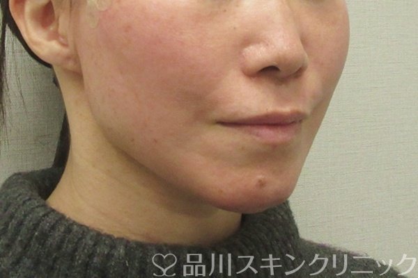 症例NO.75393のAFTER写真