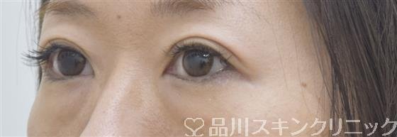 症例NO.52460のAFTER写真