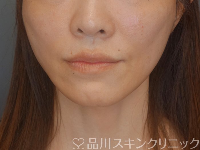 症例NO.72519のAFTER写真