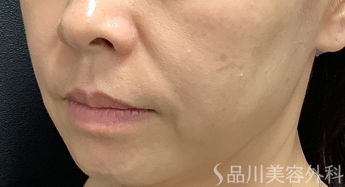 症例NO.75292のBEFORE写真