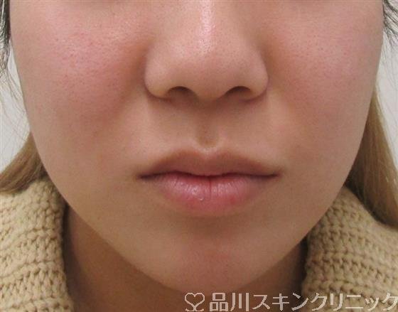 症例NO.42240のBEFORE写真
