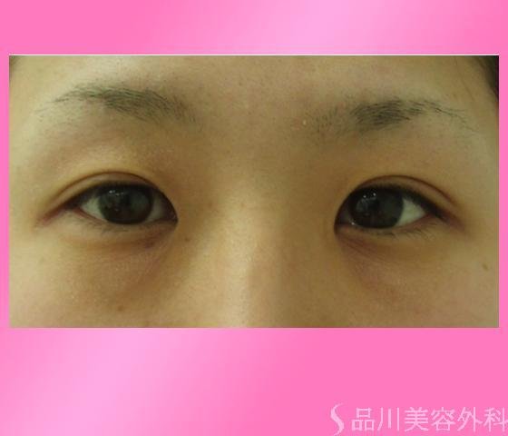 症例NO.2528のBEFORE写真