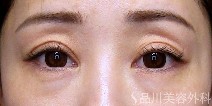 症例NO.75145のBEFORE写真