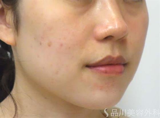 症例NO.26263のAFTER写真