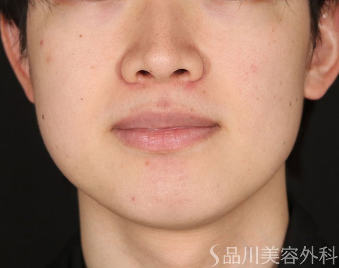 症例NO.73266のBEFORE写真