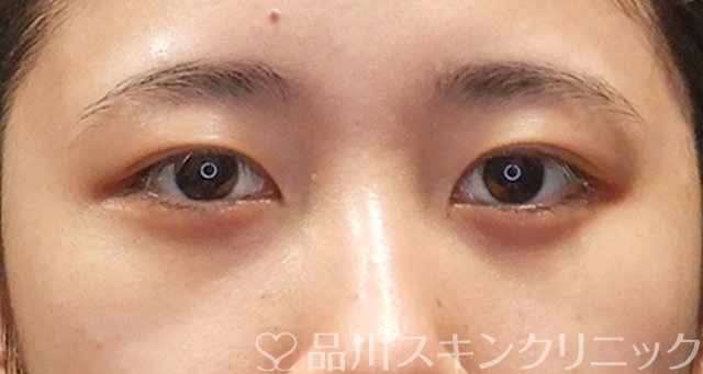 症例NO.75057のAFTER写真