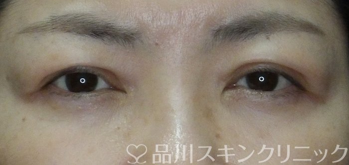 症例NO.67467のAFTER写真