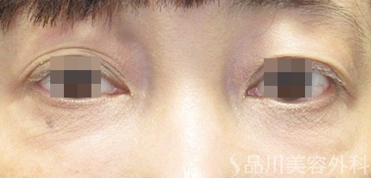 症例NO.71003のBEFORE写真