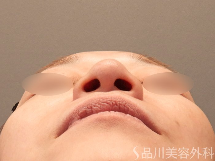 症例NO.70922のBEFORE写真