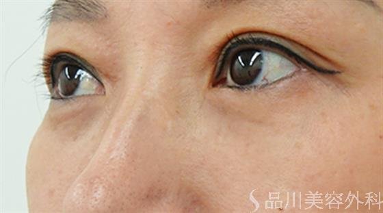 症例NO.46605のAFTER写真