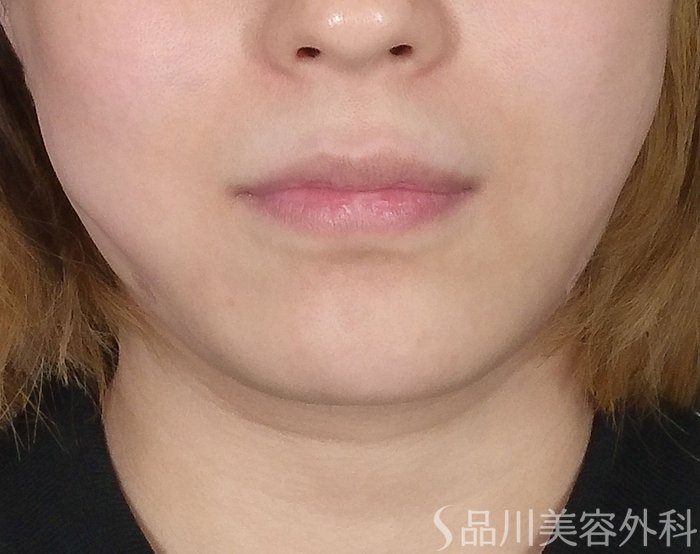 症例NO.64748のAFTER写真