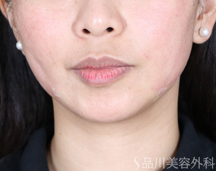 症例NO.73128のAFTER写真