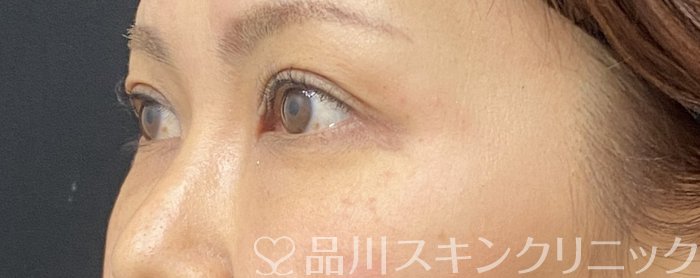 症例NO.74873のAFTER写真