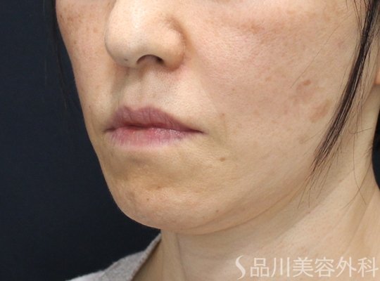 症例NO.75262のAFTER写真