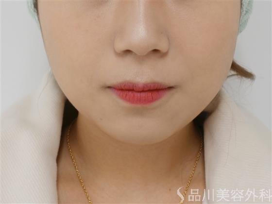 症例NO.38753のBEFORE写真