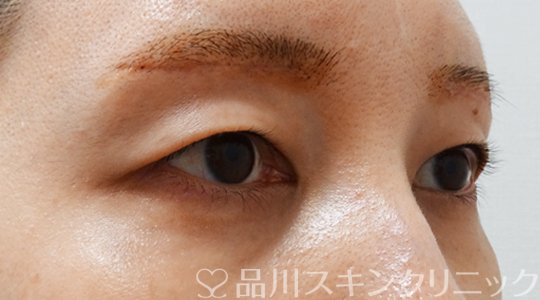 症例NO.70162のAFTER写真