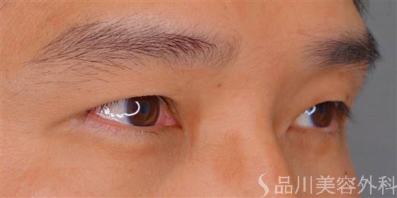 症例NO.57176のBEFORE写真