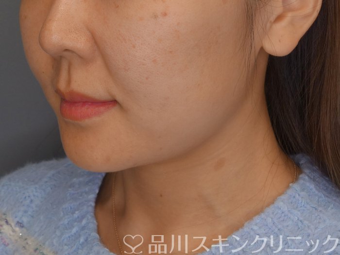 症例NO.72925のBEFORE写真