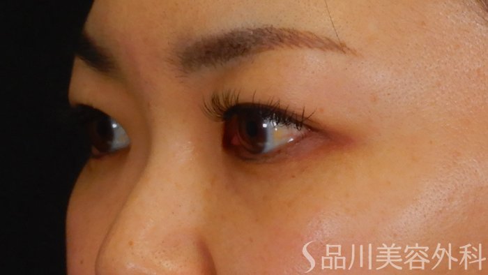 症例NO.67403のBEFORE写真