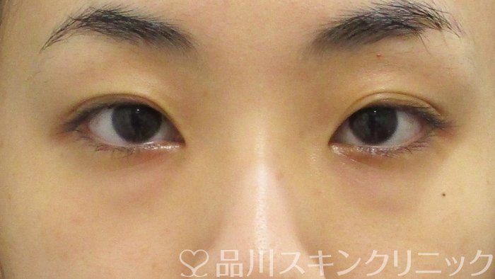 症例NO.70919のBEFORE写真