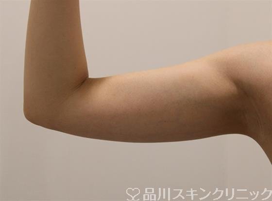 症例NO.47161のBEFORE写真