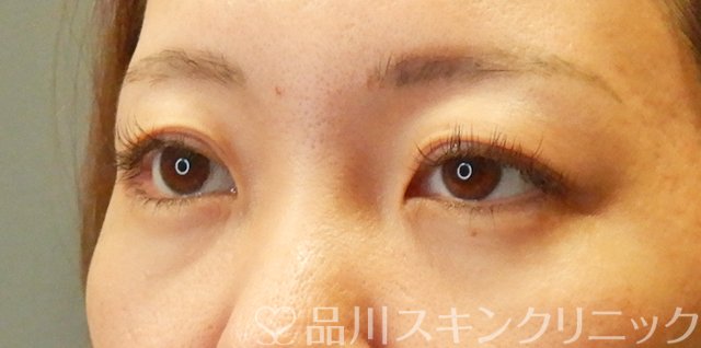 症例NO.66571のBEFORE写真