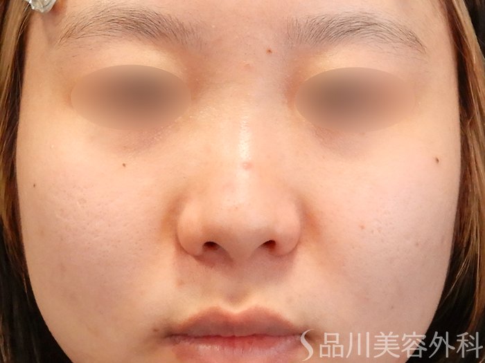 症例NO.71910のBEFORE写真