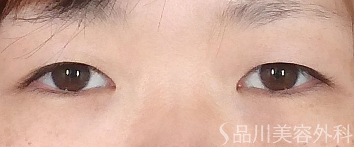症例NO.70595のBEFORE写真