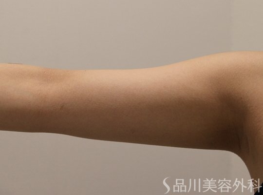 症例NO.72755のAFTER写真