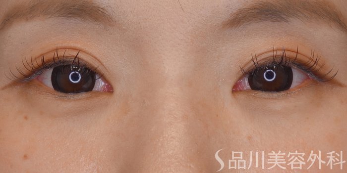 症例NO.69620のBEFORE写真