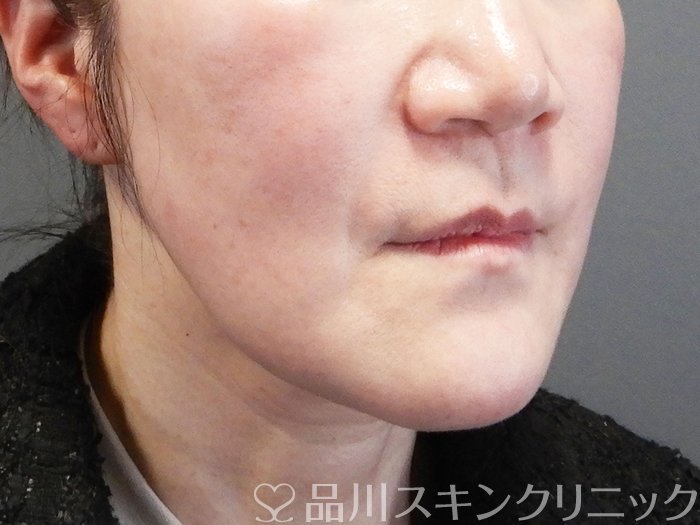 症例NO.73576のBEFORE写真