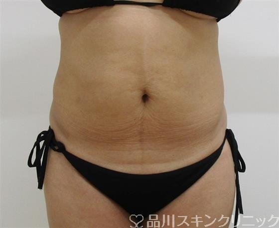 症例NO.35946のAFTER写真