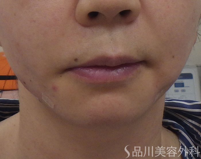 症例NO.71833のAFTER写真