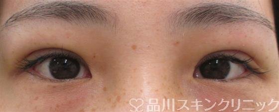症例NO.26965のAFTER写真