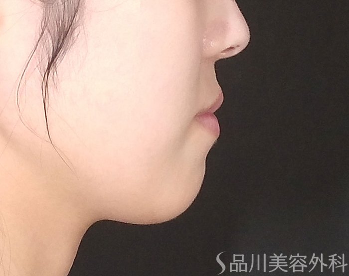 症例NO.70103のBEFORE写真