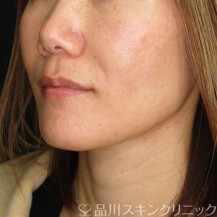 症例NO.69818のBEFORE写真