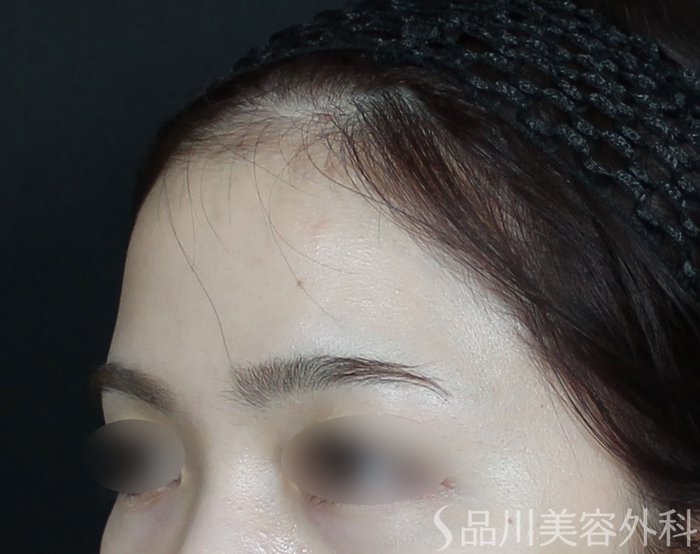 症例NO.73433のBEFORE写真