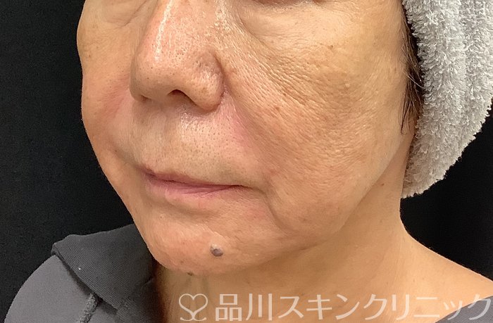 症例NO.67983のAFTER写真