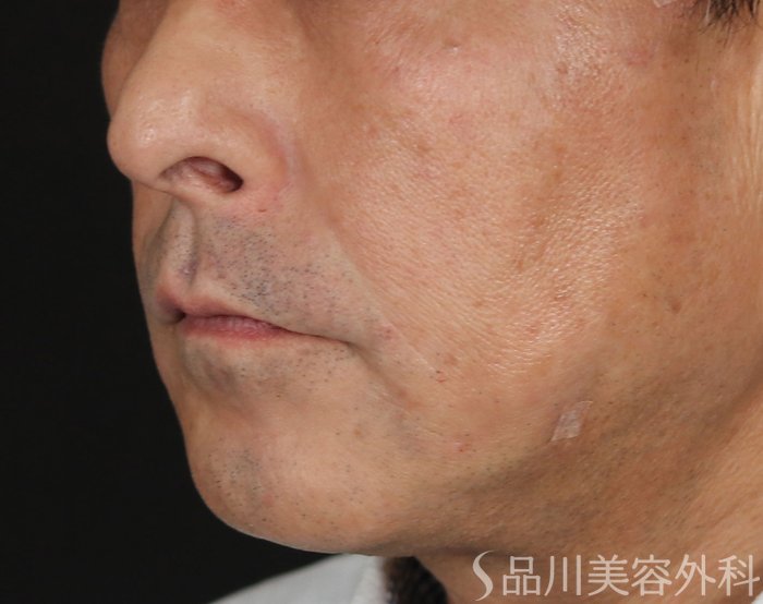 症例NO.71607のAFTER写真